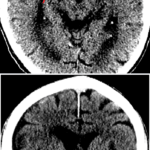 Dense MCA sign in R hemisphere