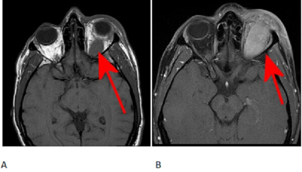 orbital tumor MRI findings