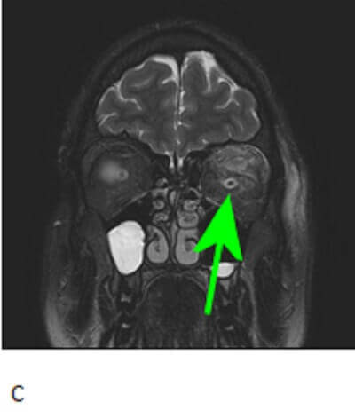 orbital tumor MRI findings