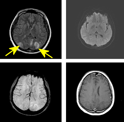 PRES - posterior reversible encephalopathy syndrome