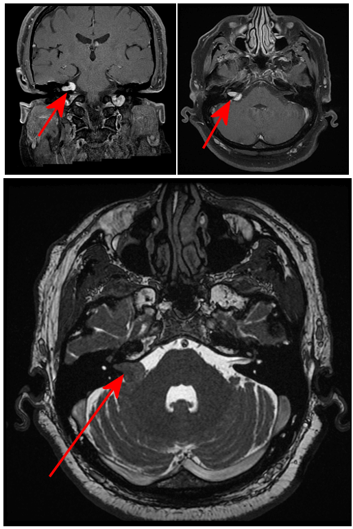 Vestibular schwannoma | acoustic neuroma | acoustic schwannoma Tumor in the CPA