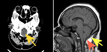 Chiari malformation Type 1