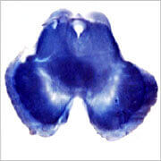 Neurodegenerative diseases