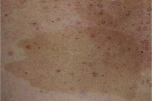 Attribution: 2006-02-19 22:01 Accrochoc through http://en.wikipedia.org/wiki/File:NF-1-Tache_cafe-au-lait.jpg Creative Commons Attribution-Share Alike license