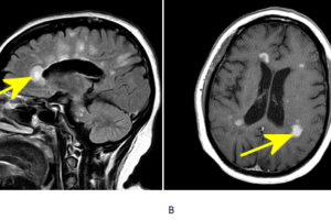 Dawson's fingers of MS