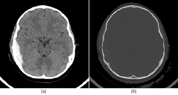 Epidural hematoma on CT