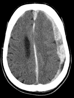 Subdural hematoma on CT