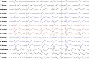 Characteristic 1 Hz spike and wave EEG of CJD