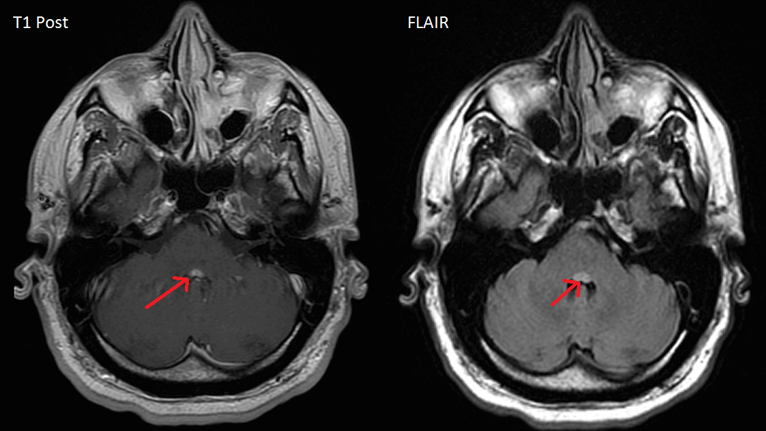 Facial colliculus MRI