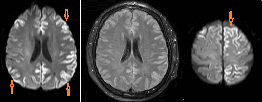Cortical ribbons on DWI characteristic of CJD