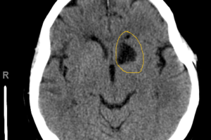 Infarct of the left recurrent artery of Heubner