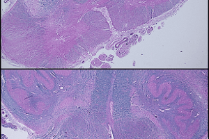 ALS spinal cord pathology