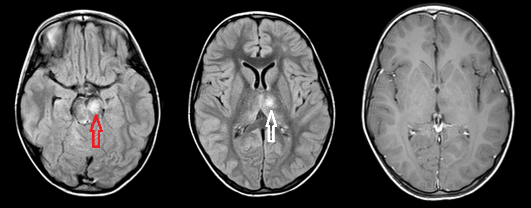 ADEM acute disseminated encephalomyelitis on MRI