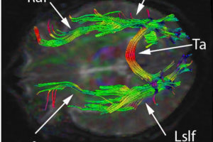 Cerebral white matter tracts by diffusion tensor imaging. Licensed under Creative Commons Attribution-Share Alike 3.0 via Wikimedia Commons