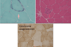 Mitochondrial myopathy seen on H&E stain, trichrome stain, CO stain