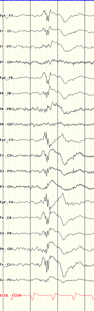 polyspikes JME Juvenile Myoclonic Epilepsy: polyspike and wave EEG